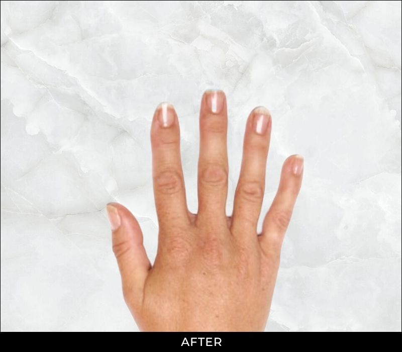 Angel Aesthetics of Fort Lauderdale - Hand Rejuvenation - -After Treatment