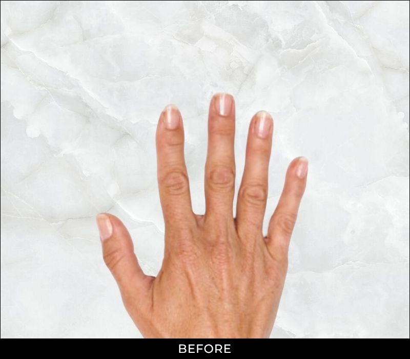 Angel Aesthetics of Fort Lauderdale - Hand Rejuvenation - Before Treatment
