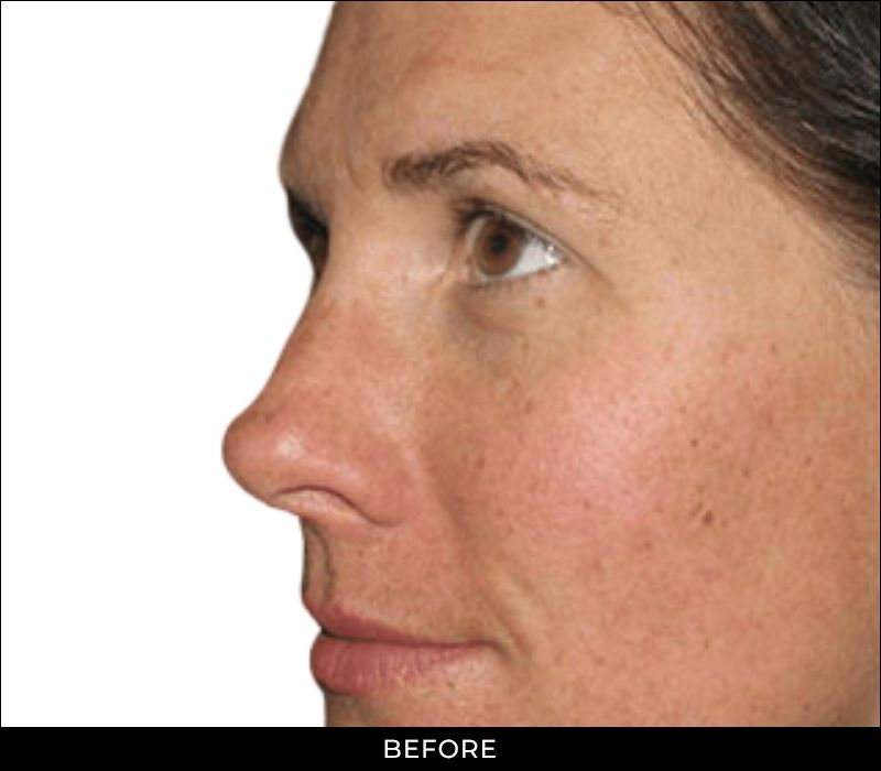 Angel Aesthetics of Fort Lauderdale - Red and Brown Spot Removal - Before