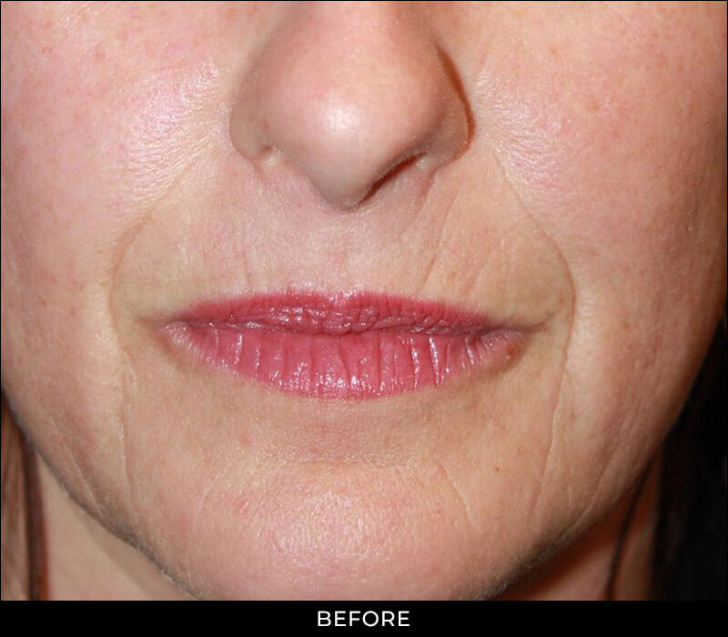 Angel Aesthetics of Fort Lauderdale - Collagen Induction Therapy Before Treatment