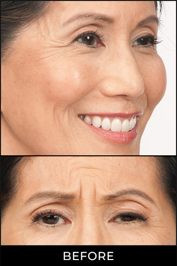 Angel Aesthetics of Fort Lauderdale clients before and afters results - Botox Juvederm Treatment