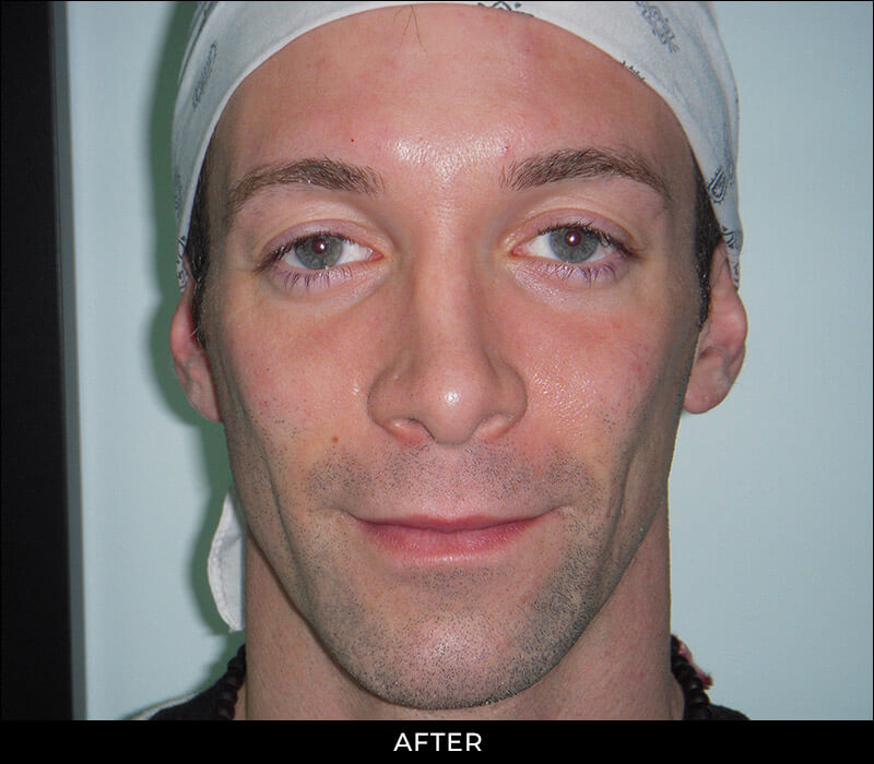 Angel Aesthetics of Fort Lauderdale clients before and afters results - Cheek Lift