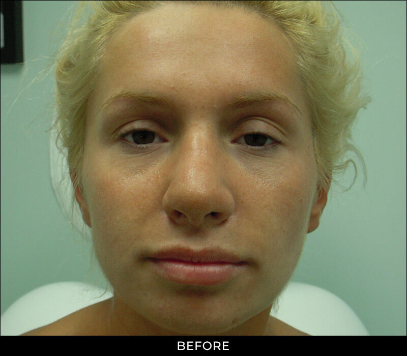 Angel Aesthetics of Fort Lauderdale clients before and afters results - Cheek Lift
