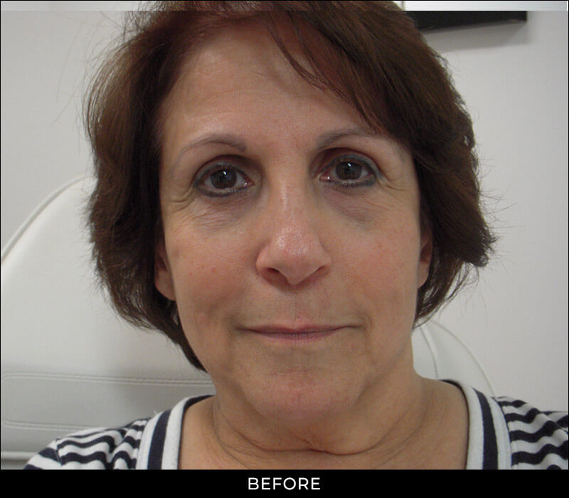 Angel Aesthetics of Fort Lauderdale clients before and afters results - Liquid Facelift