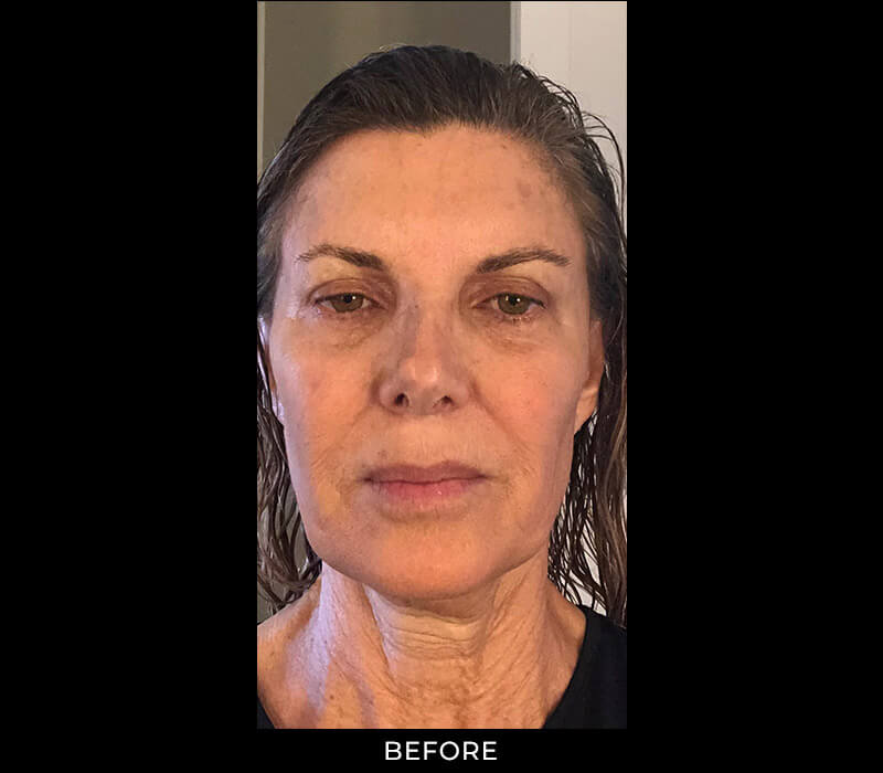 Angel Aesthetics of Fort Lauderdale clients before and afters results - Liquid Facelift