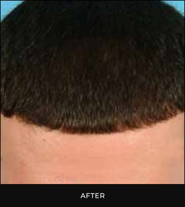 Angel Aesthetics of Fort Lauderdale clients before and afters results - Hair Restoration Treatment