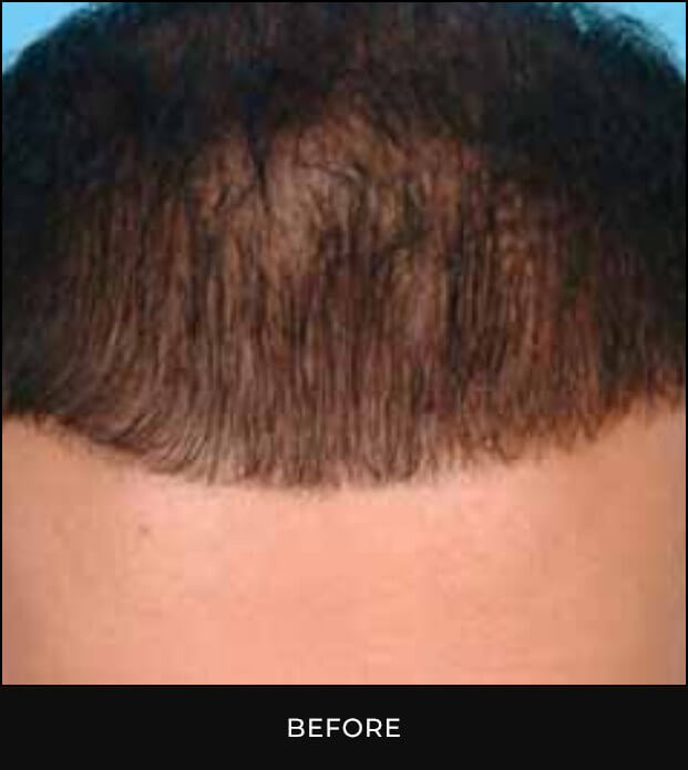 Angel Aesthetics of Fort Lauderdale clients before and afters results - Hair Restoration Treatment