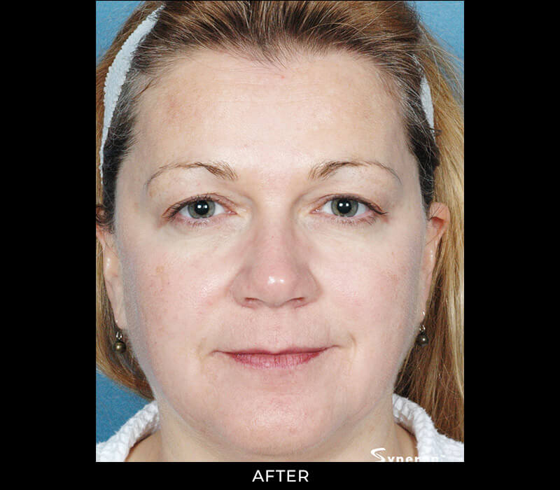 Angel Aesthetics of Fort Lauderdale clients before and afters results - Laser Treatment