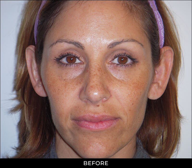 Angel Aesthetics of Fort Lauderdale clients before and afters results - Laser Treatment