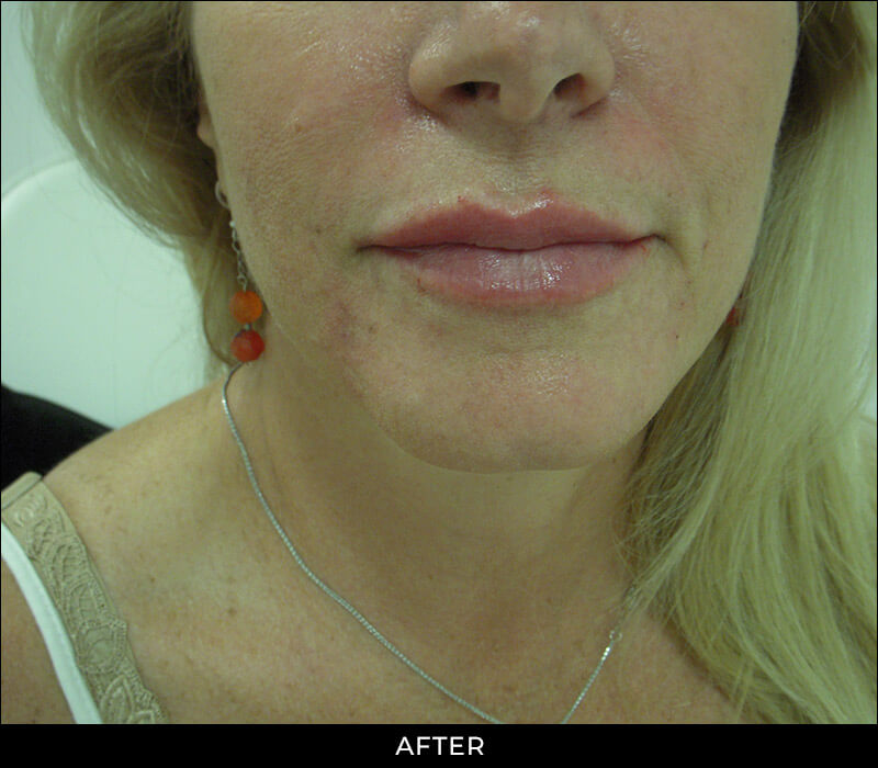 Angel Aesthetics of Fort Lauderdale clients before and afters results - Lips Enhancements