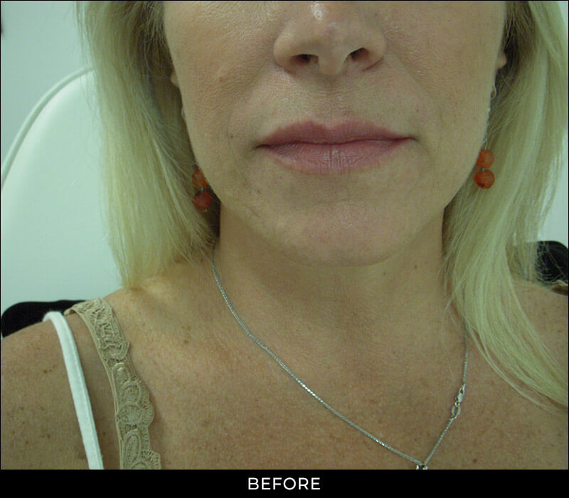 Angel Aesthetics of Fort Lauderdale clients before and afters results - Lips Enhancements