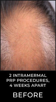 Angel Aesthetics of Fort Lauderdale clients before and afters results - Hair Restoration Treatment - PRP Procedure