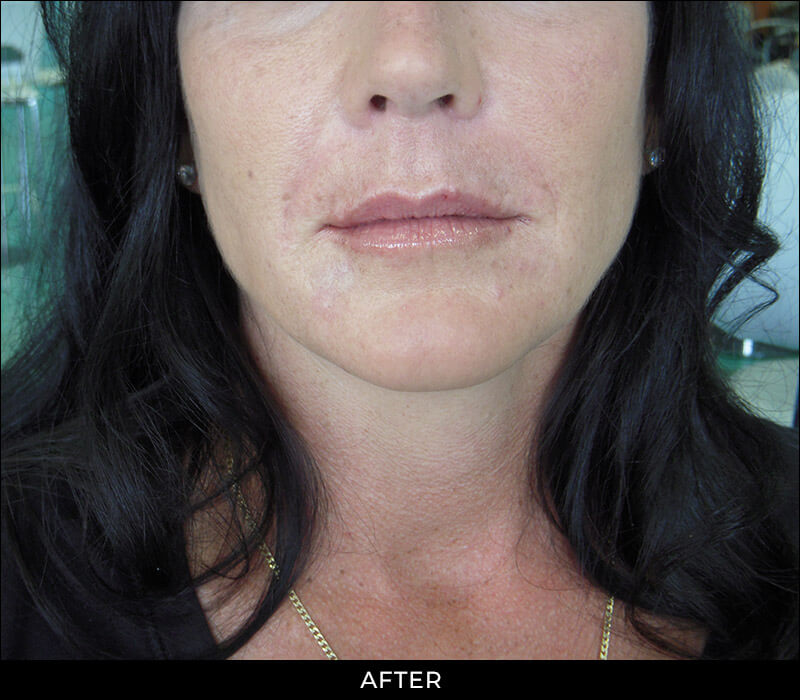 Angel Aesthetics of Fort Lauderdale clients before and afters results - Smile Lines