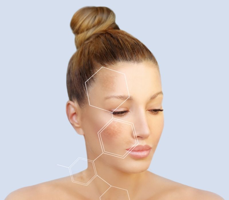 Angel Aesthetics of Fort Lauderdale - Skin Rejuvenation - CO2 Pixel Laser